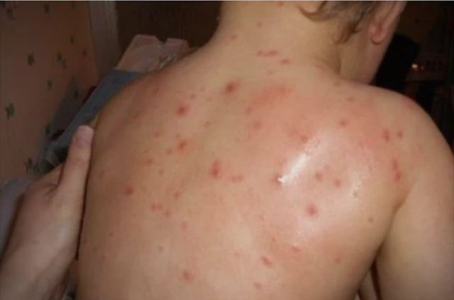 Απειλή προ των πυλών: Eπιδημία ιλαράς στα Σκόπια